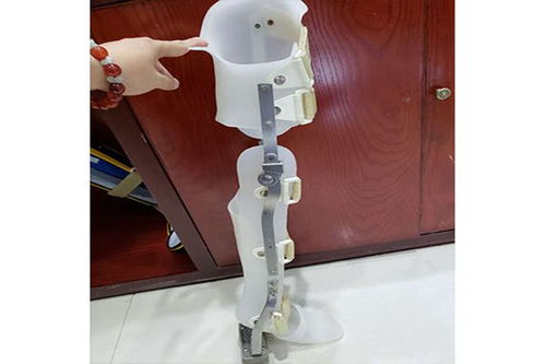 假肢與矯形器的使用周期與更換指南 科學維護，保障生活品質